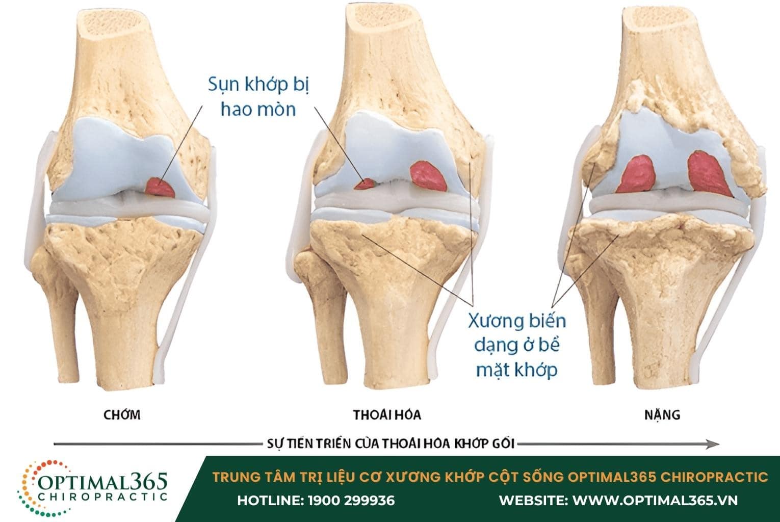 Tình trạng mãn tính: Dấu hiệu bệnh lý xương khớp