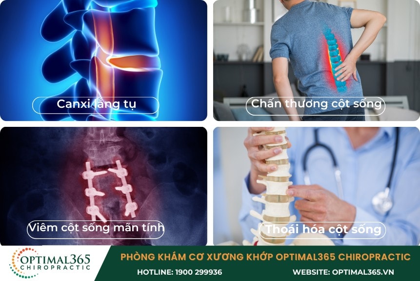 Nguyên nhân gây bệnh gai cột sống