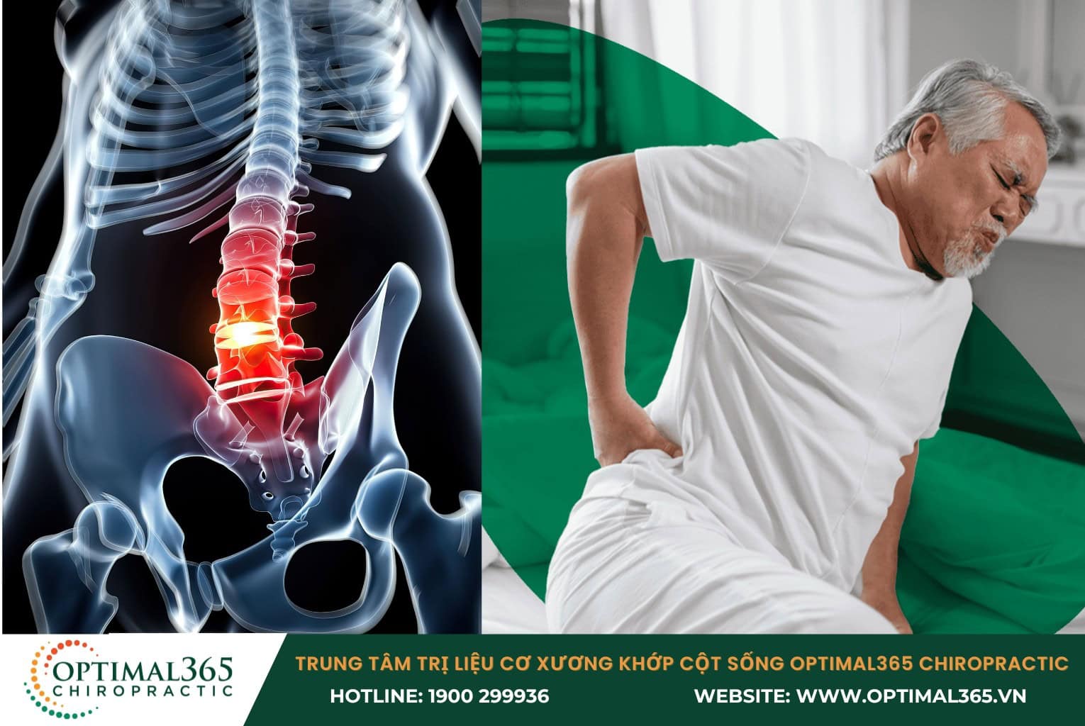 Tổng quan về thoái hoá cột sống