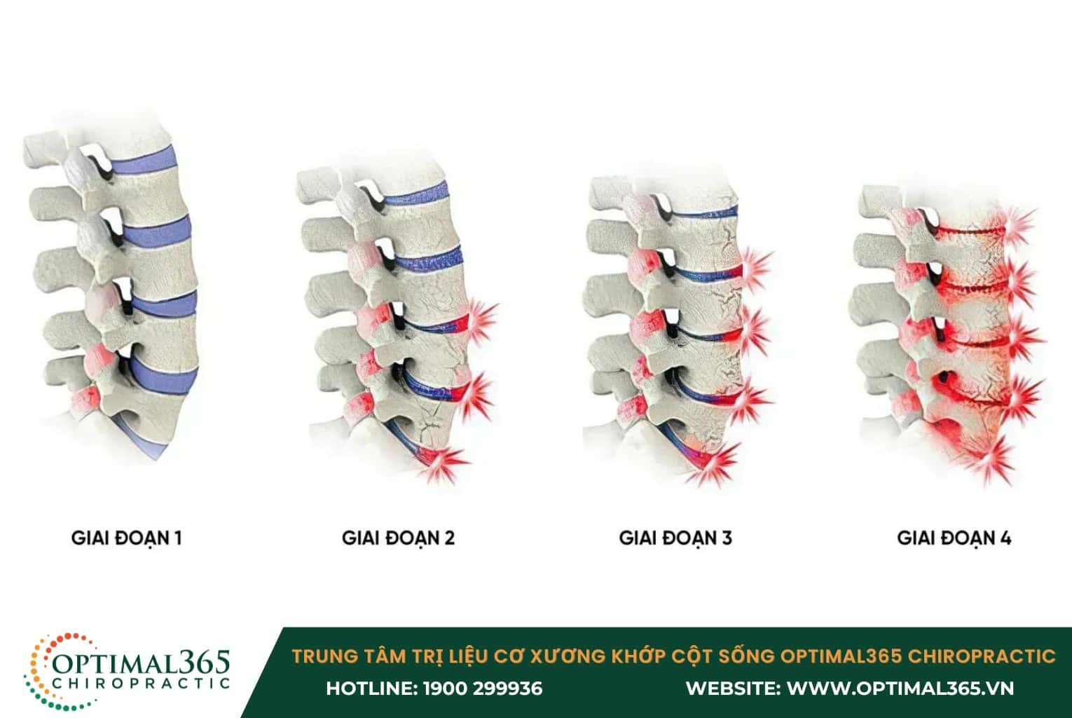 Các giai đoạn của thoái hoá cột sống
