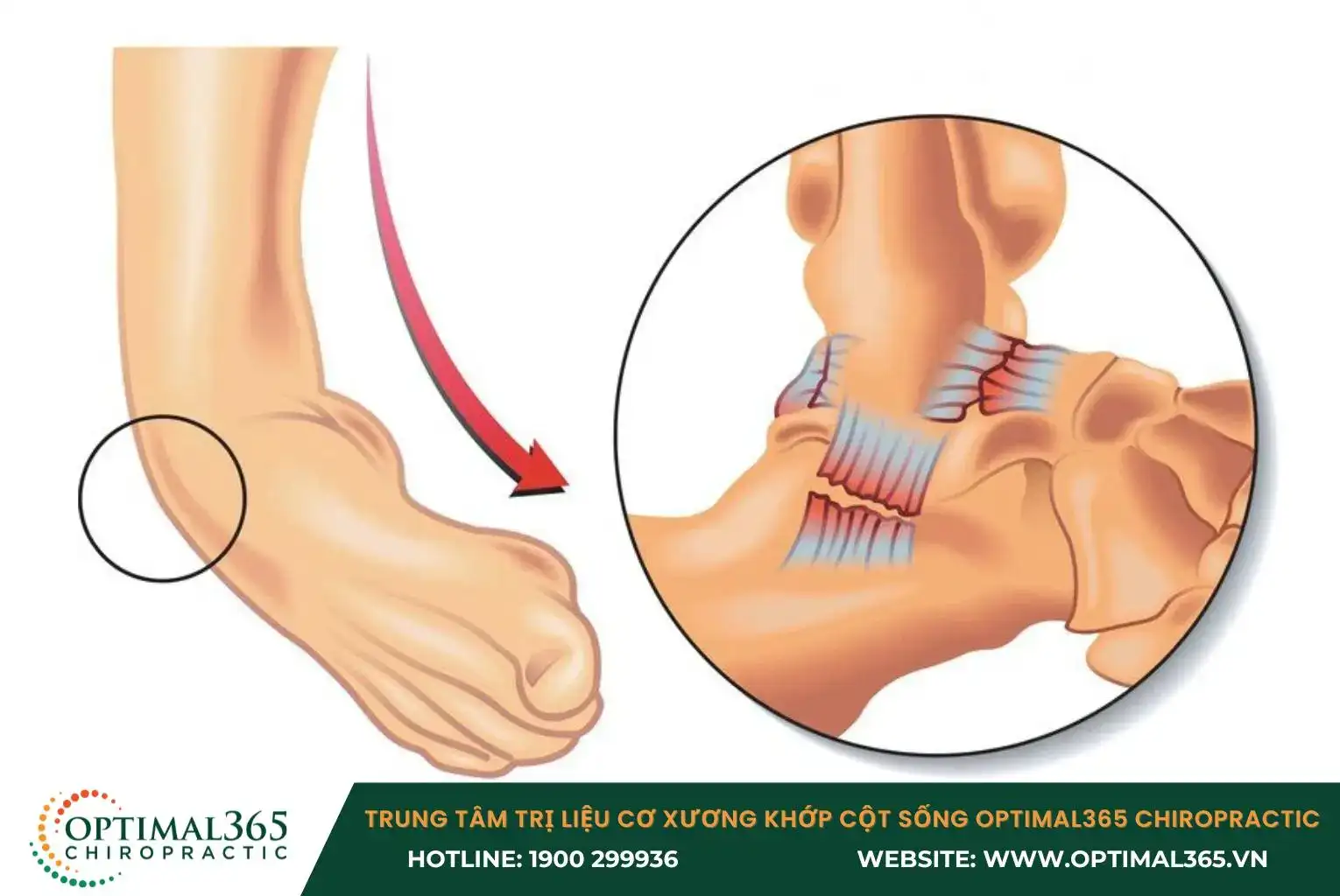 Khi bàn chân bị lật ra ngoài, dây chằng deltoid sẽ bị tổn thương dẫn đến bong gân Khi bàn chân bị lật ra ngoài, dây chằng deltoid sẽ bị tổn thương dẫn đến bong gân