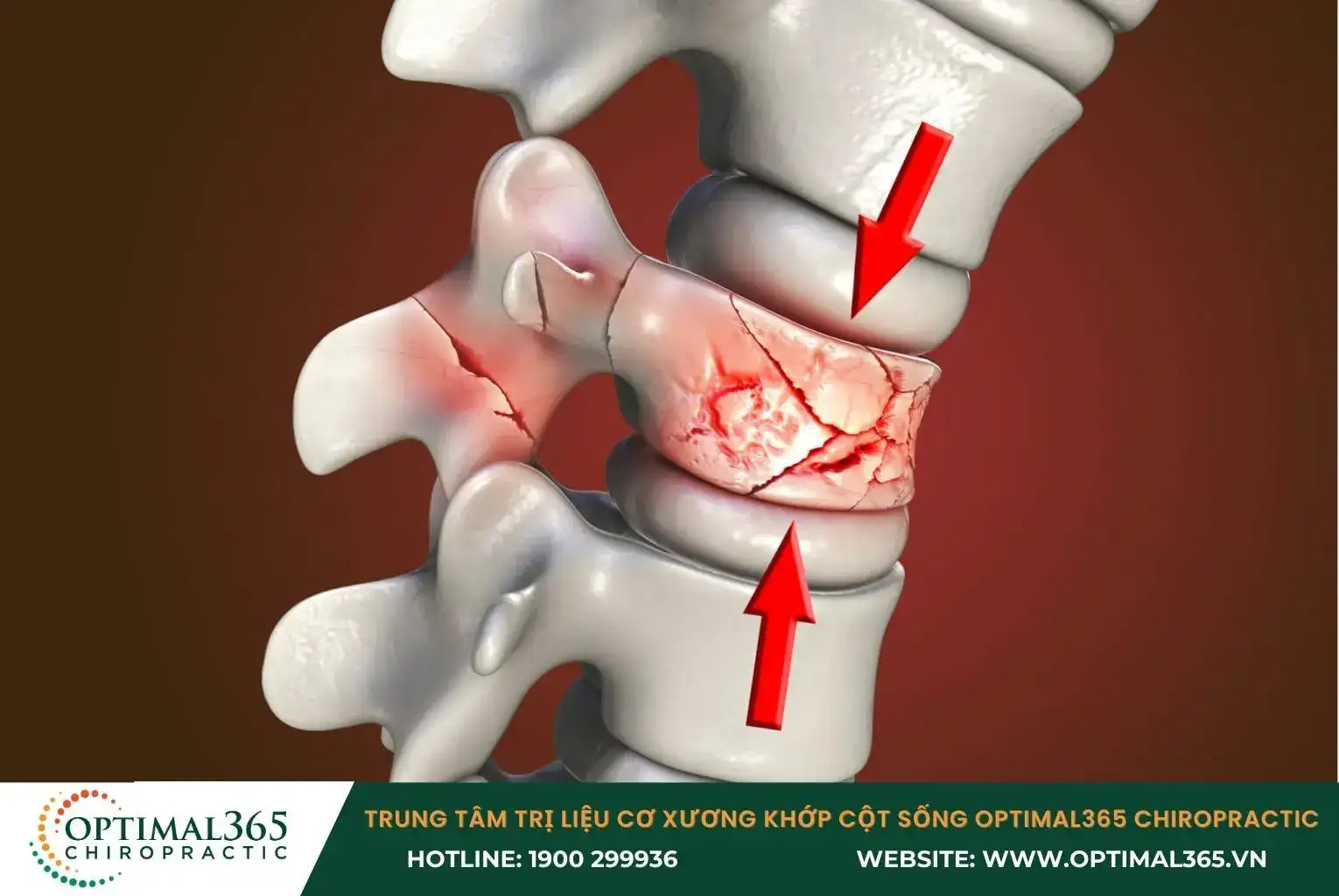 Tổn thương đốt sống Tổn thương đốt sống