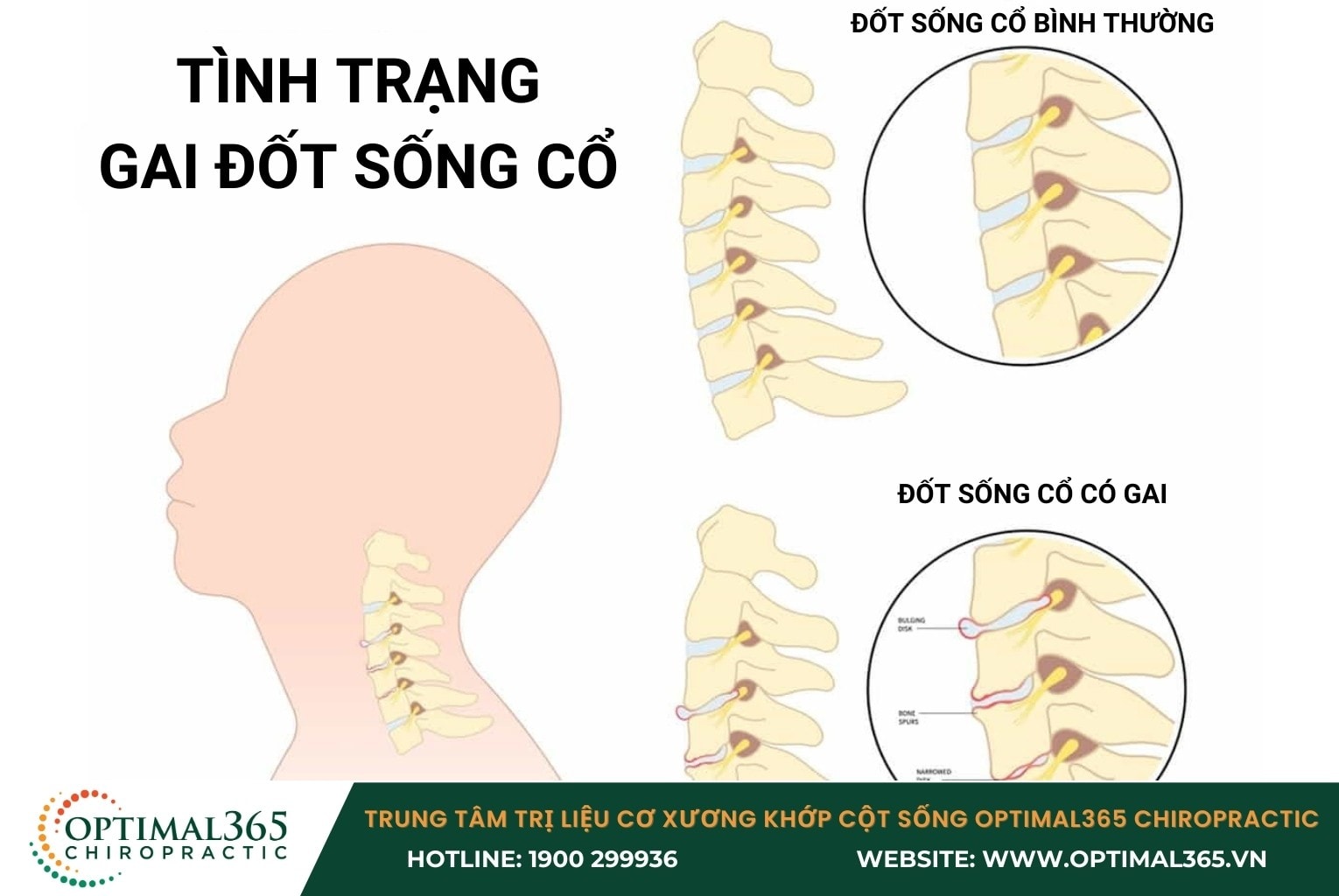 Gai xương cổ