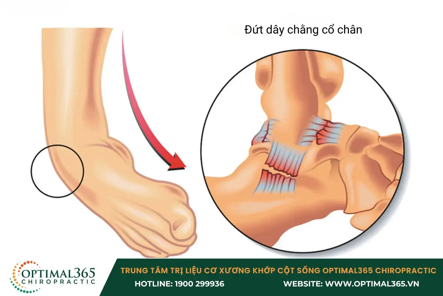 Khi dây chằng bị kéo căng quá mức, chúng có thể bị rách hoặc đứt hoàn toàn Khi dây chằng bị kéo căng quá mức, chúng có thể bị rách hoặc đứt hoàn toàn