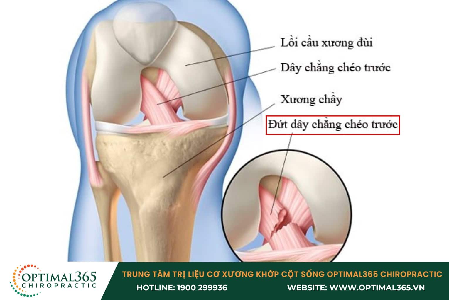 Hình ảnh X quang chẩn đoán giãn dây chằng khớp gối Khi bị chấn thương ACL, dây chằng có thể bị giãn, rách một phần hoặc rách hoàn toàn