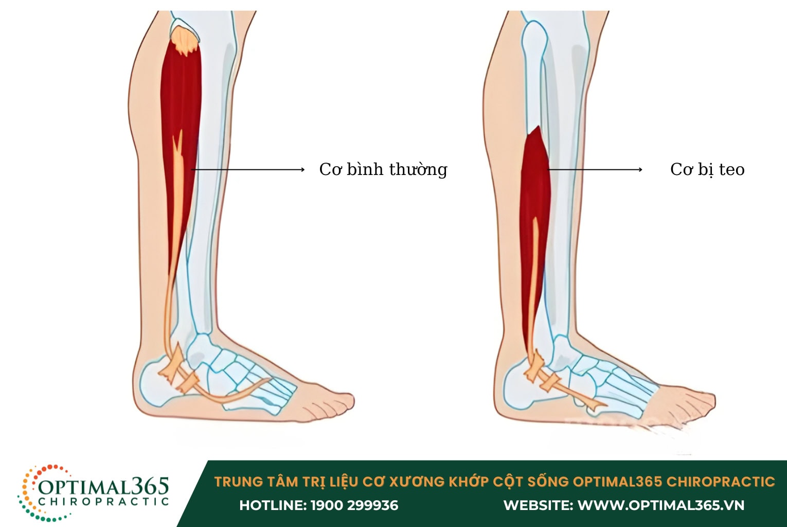 Hình ảnh X quang chẩn đoán giãn dây chằng khớp gối Chấn thương dây chằng đầu gối thường dẫn đến tình trạng teo cơ đùi