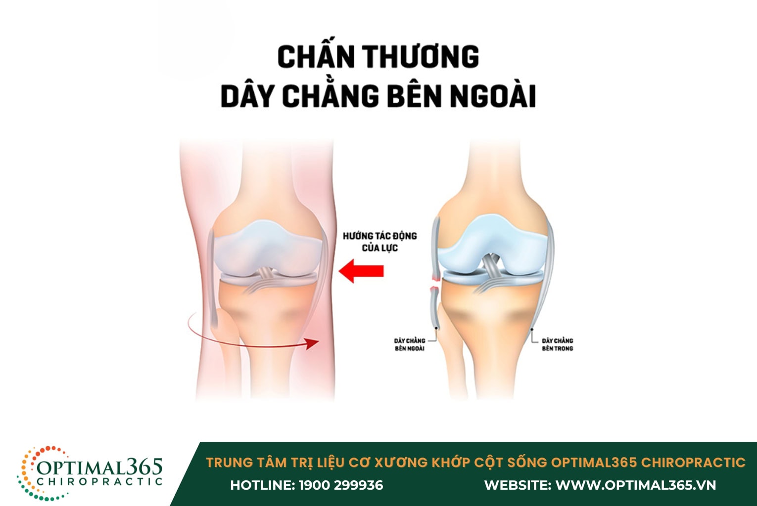 Hình ảnh X quang chẩn đoán giãn dây chằng khớp gối Chấn thương dây chằng MCL thường xuất hiện sau chấn thương và có thể tăng lên khi vận động