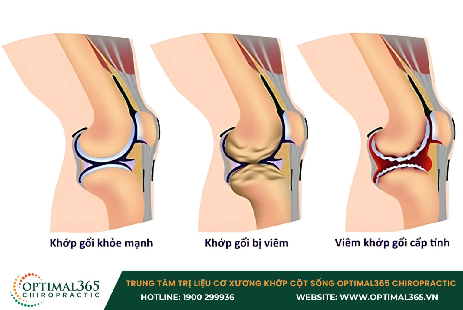 Hình ảnh X quang chẩn đoán giãn dây chằng khớp gối Đau mãn tính ở khớp gối là biến chứng do tổn thương dây chằng và sụn chêm