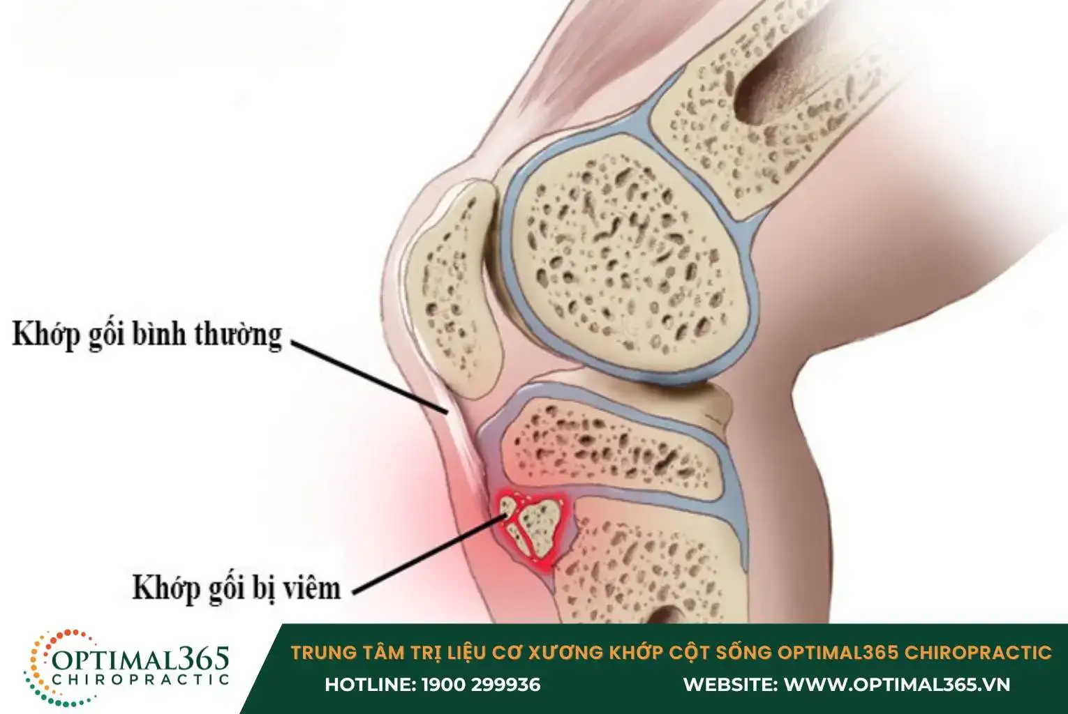 Chronic condition: Signs of joint disease