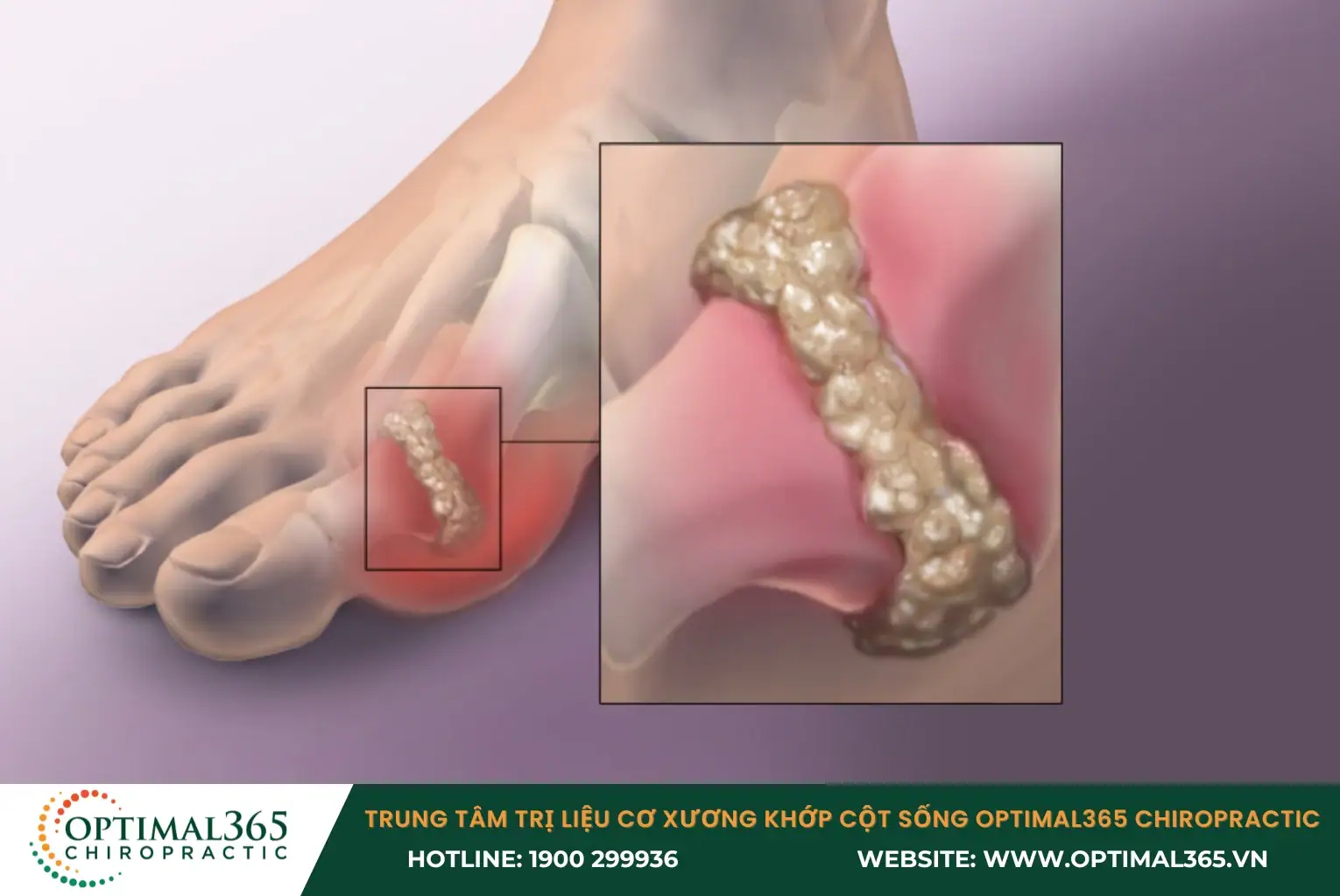 Bệnh gout gây đau đột ngột, sưng đỏ, nóng khớp Bệnh gout gây đau đột ngột, sưng đỏ, nóng khớp