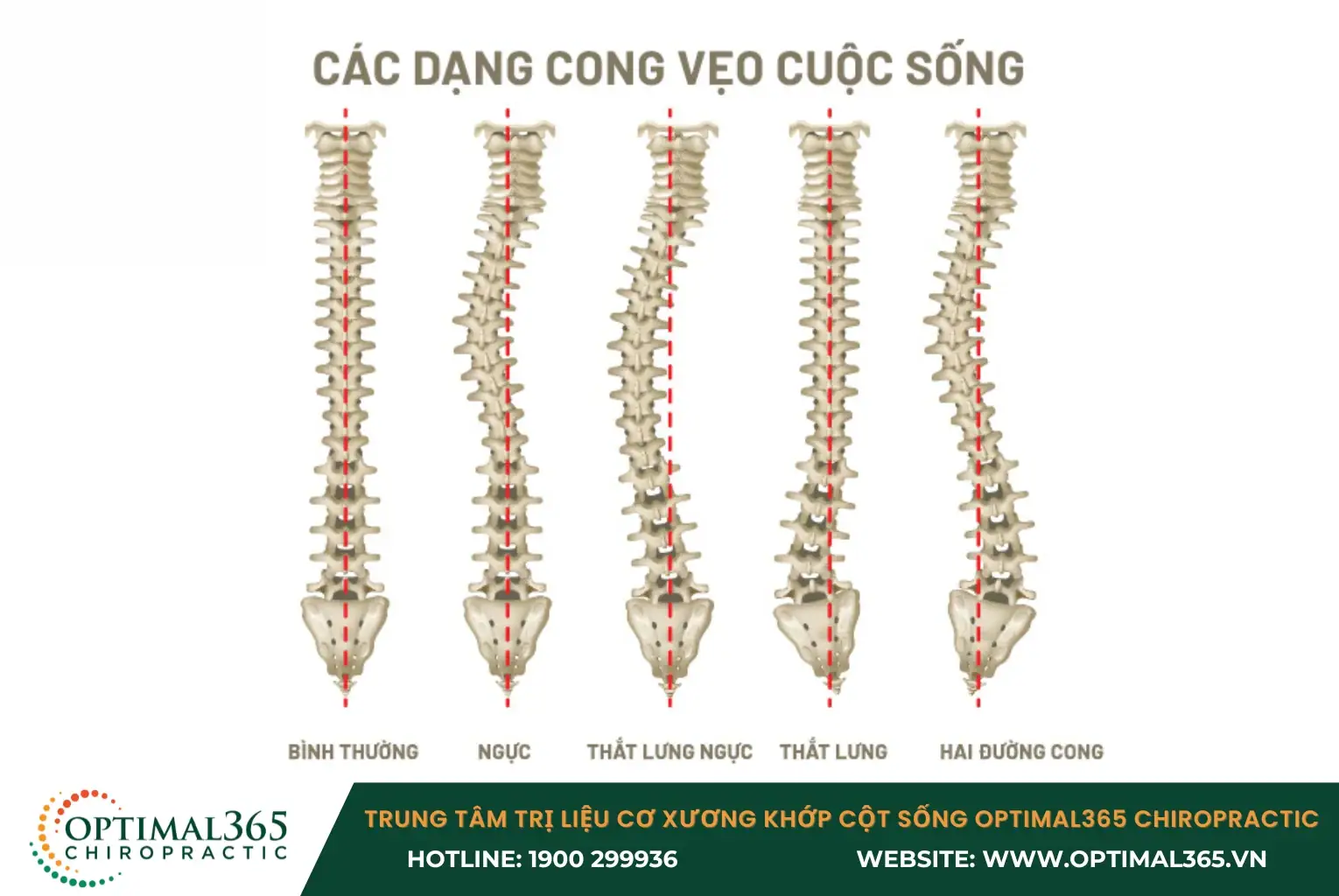 Cong vẹo cột sống có thể do bẩm sinh, thoái hóa hoặc mắc bệnh lý Cong vẹo cột sống có thể do bẩm sinh, thoái hóa hoặc mắc bệnh lý