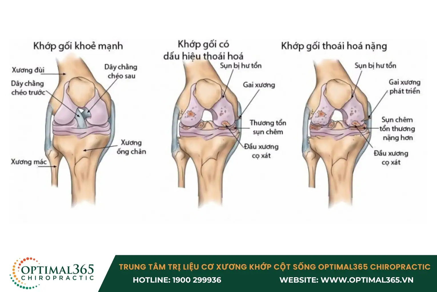 Thoái hóa khớp là tình trạng sụn khớp và xương dưới dưới sụn bị tổn thương Thoái hóa khớp là tình trạng sụn khớp và xương dưới dưới sụn bị tổn thương
