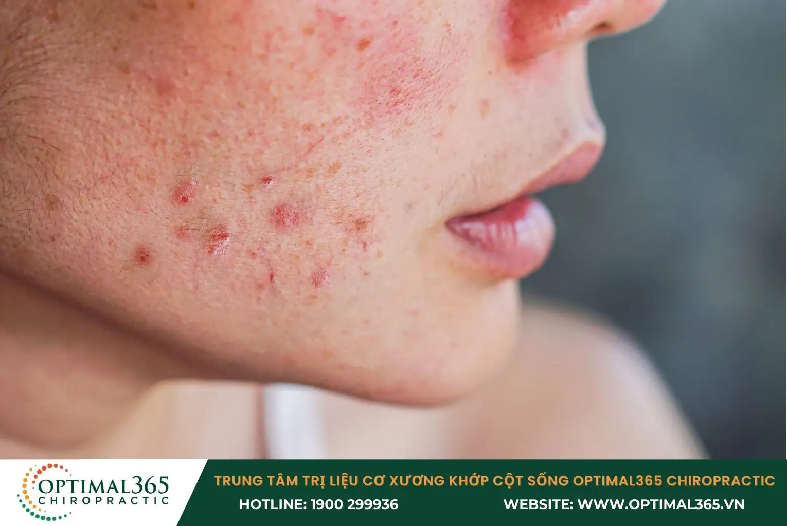 Phát ban trên da là triệu chứng phổ của lupus ban đỏ hệ thống Phát ban trên da là triệu chứng phổ của lupus ban đỏ hệ thống