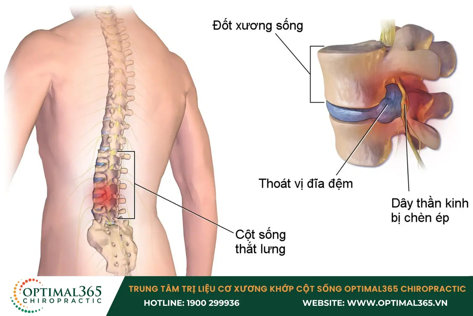 Thoát vị đĩa đệm cột sống thường xảy ra ở thắt lưng hoặc cổ Thoát vị đĩa đệm cột sống thường xảy ra ở thắt lưng hoặc cổ