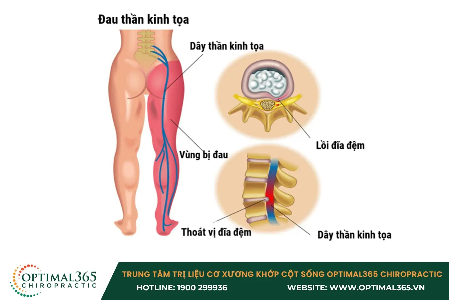 Đau dây thần kinh tọa có biểu hiện đau âm ỉ, tê nóng, như kiến bò Đau dây thần kinh tọa có biểu hiện đau âm ỉ, tê nóng, như kiến bò
