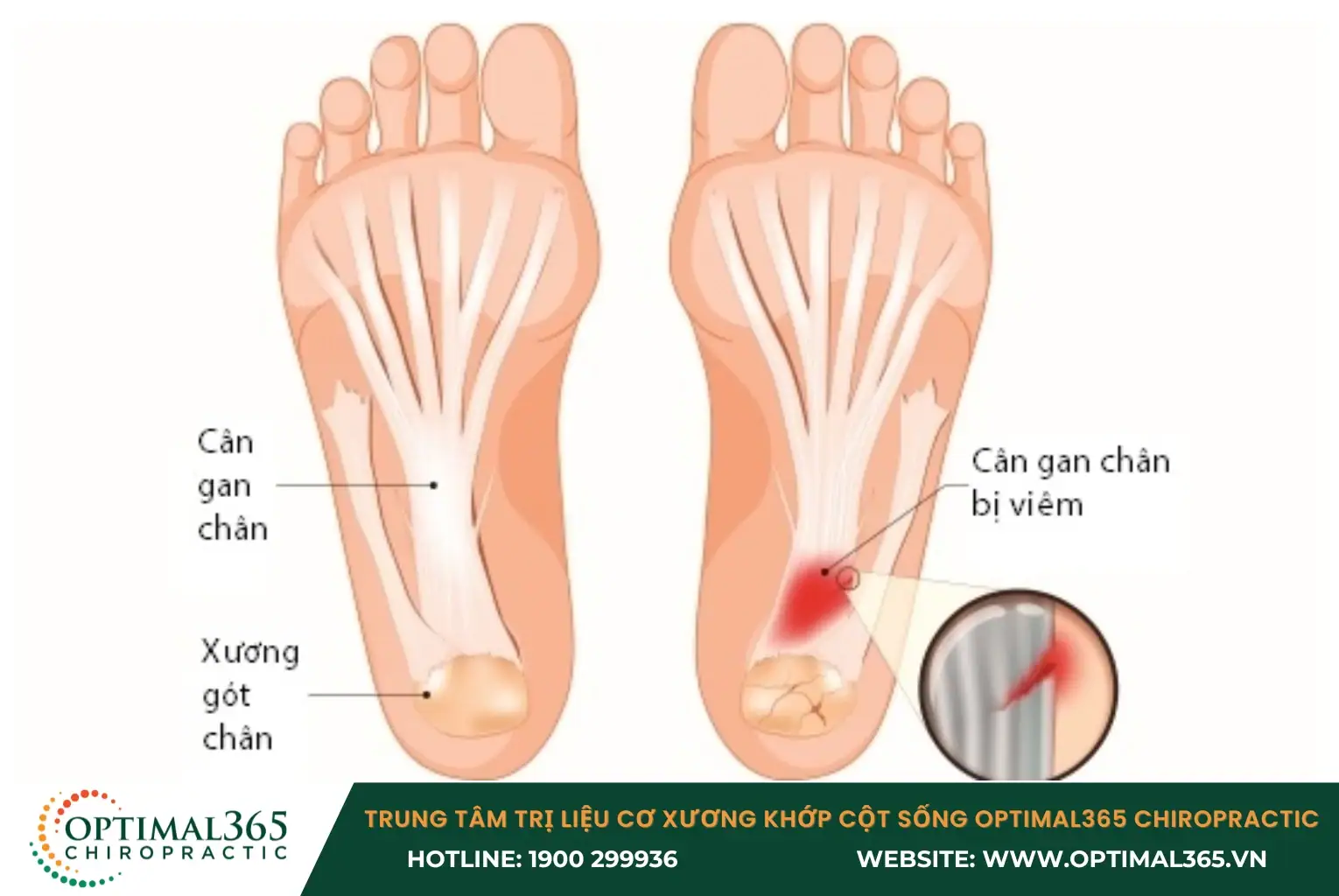 Nếu cầu thủ không khởi động kỹ trước khi thi đấu thì rất dễ bị viêm gan chân Nếu cầu thủ không khởi động kỹ trước khi thi đấu thì rất dễ bị viêm gan chân