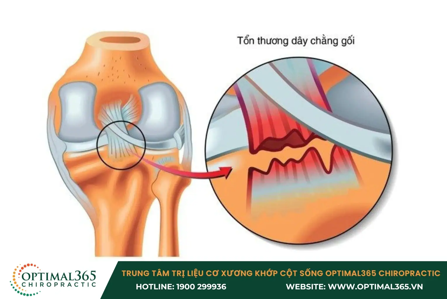 Dây chằng chéo dễ bị tổn thương khi cầu thủ đổi hướng đột ngột Dây chằng chéo dễ bị tổn thương khi cầu thủ đổi hướng đột ngột