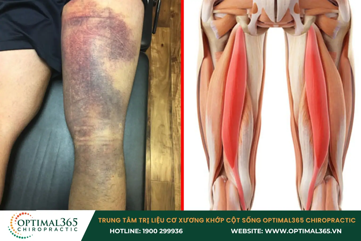 Chấn thương gân kheo do va chạm, té ngã đột ngột trong quá trình vận động Chấn thương gân kheo do va chạm, té ngã đột ngột trong quá trình vận động
