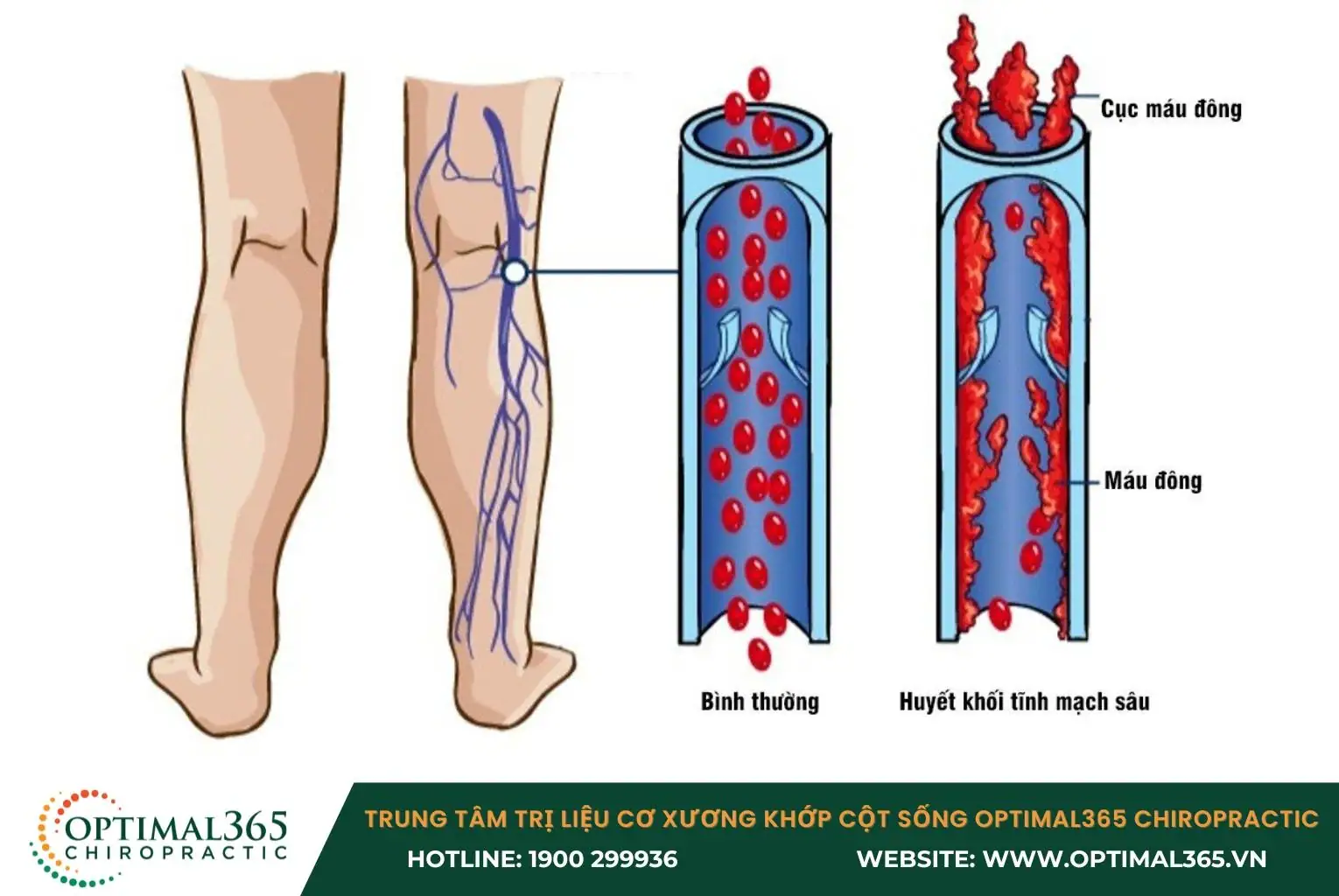 Huyết khối tĩnh mạch sâu khiến máu không thể lưu thông gây đau nhức bắp chân Huyết khối tĩnh mạch sâu khiến máu không thể lưu thông gây đau nhức bắp chân