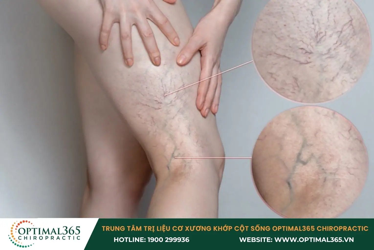 Suy giãn tĩnh mạch chi dưới sẽ dẫn đến triệu chứng đau bắp chân Suy giãn tĩnh mạch chi dưới sẽ dẫn đến triệu chứng đau bắp chân