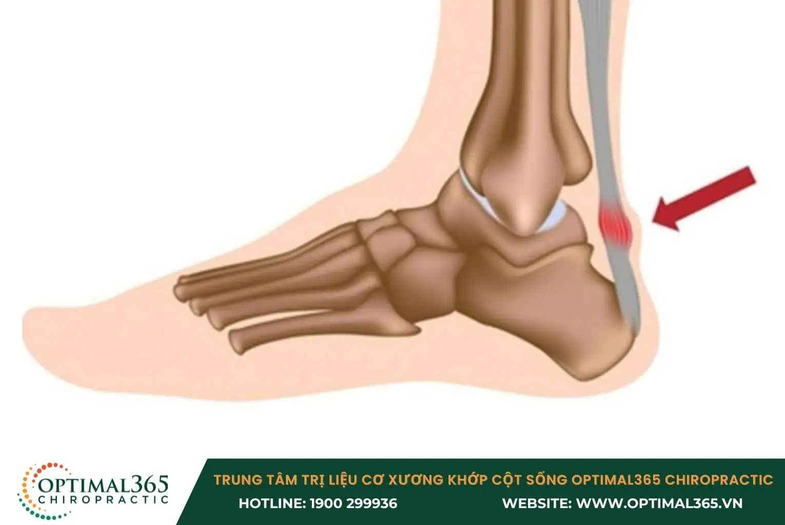 Viêm gân Achilles là một trong những nguyên nhân gây đau bắp chân Viêm gân Achilles là một trong những nguyên nhân gây đau bắp chân