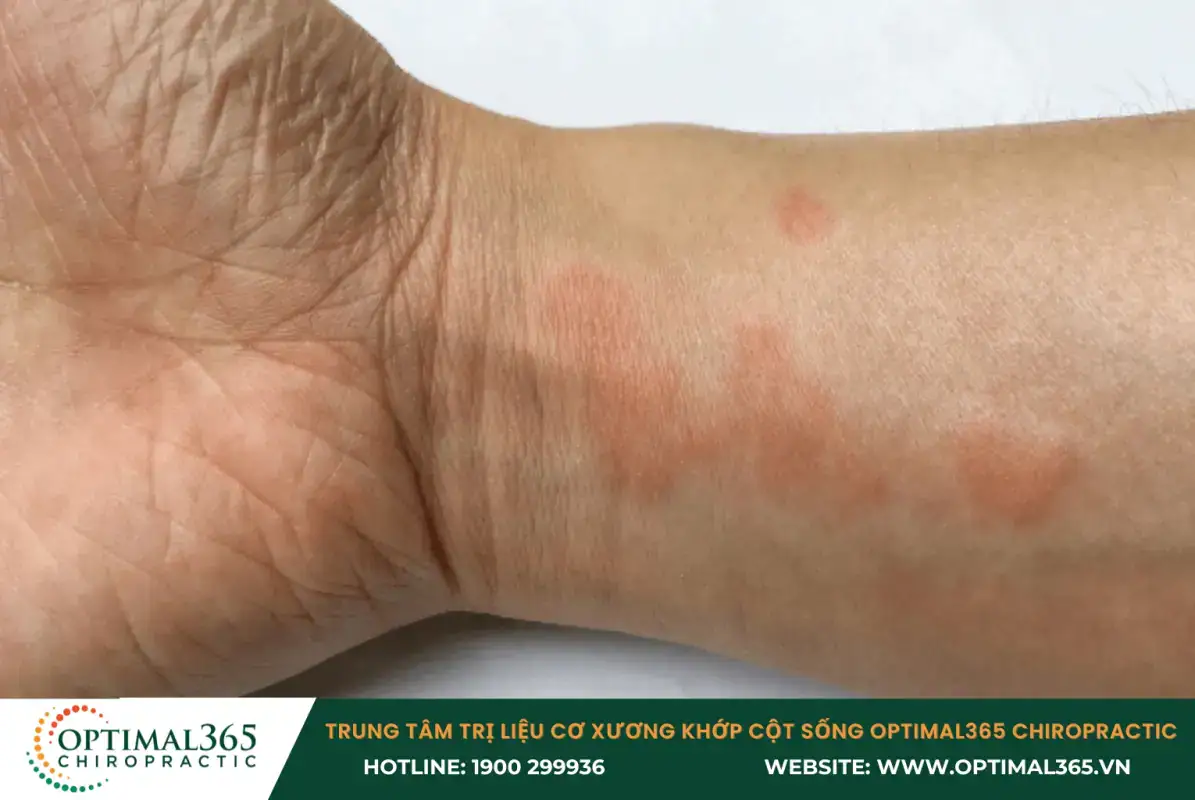 Bệnh Lupus ban đỏ là nguyên nhân gây đau và sưng khớp Bệnh Lupus ban đỏ là nguyên nhân gây đau và sưng khớp