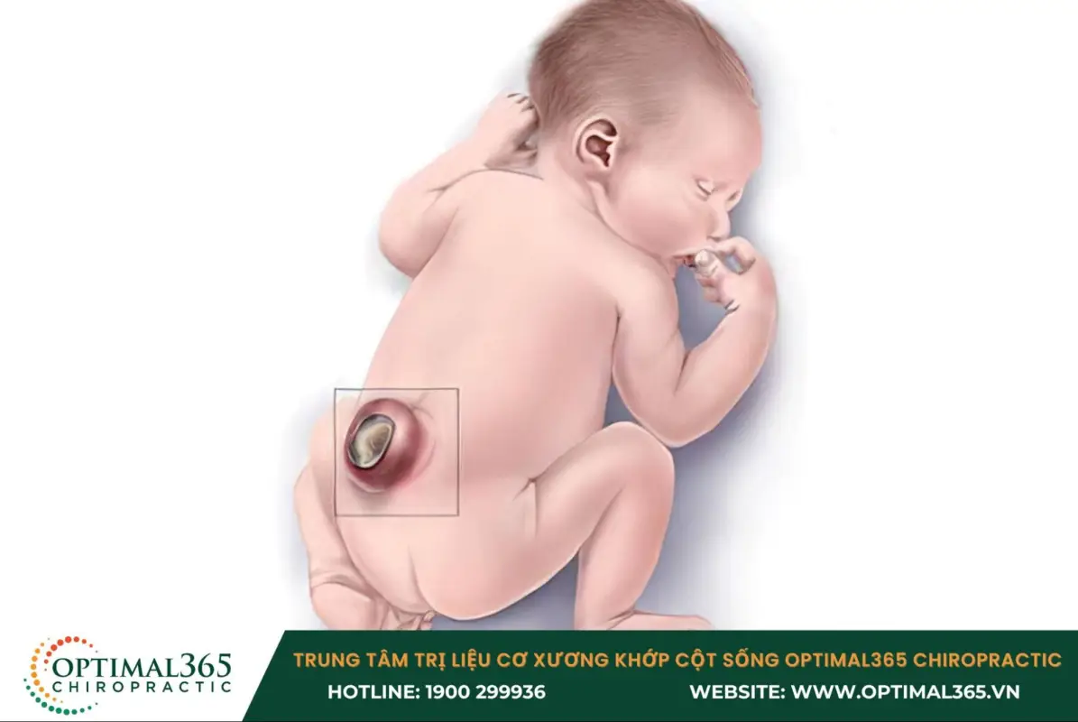 Bệnh gai đôi cột sống S1 ở trẻ thường dẫn đến rối loạn hô hấp Bệnh gai đôi cột sống S1 ở trẻ thường dẫn đến rối loạn hô hấp