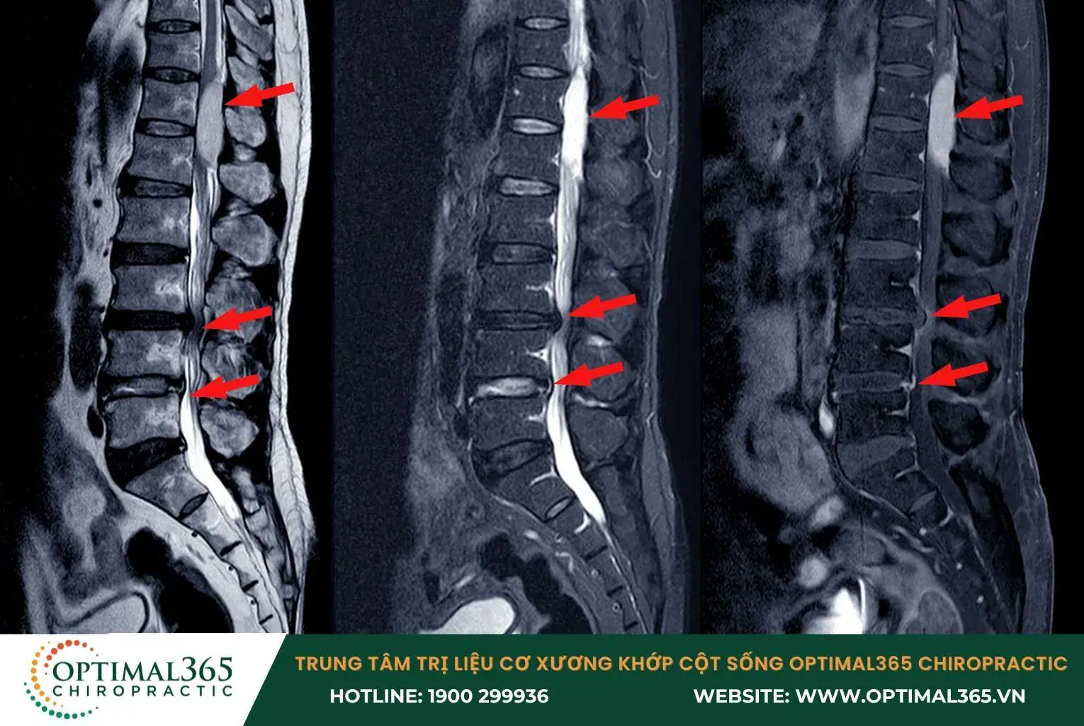 Hẹp ống sống có thể do thoái hóa đốt sống hoặc chấn thương Hẹp ống sống có thể do thoái hóa đốt sống hoặc chấn thương