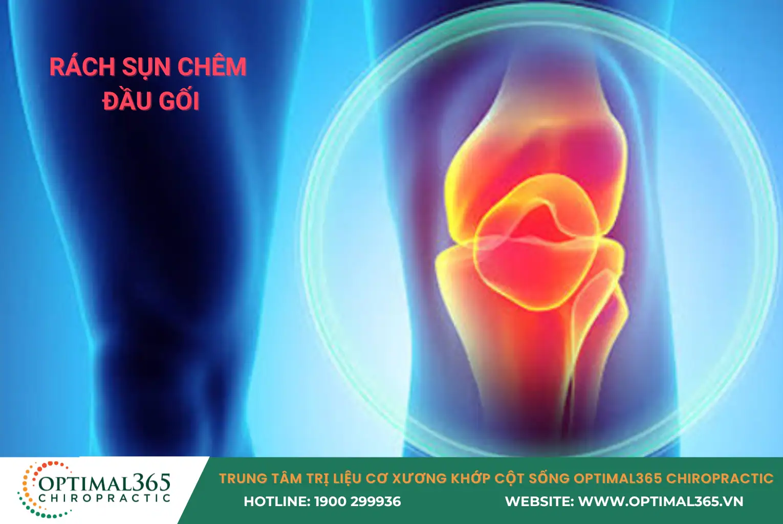 Rách sụn chêm đầu gối là gì