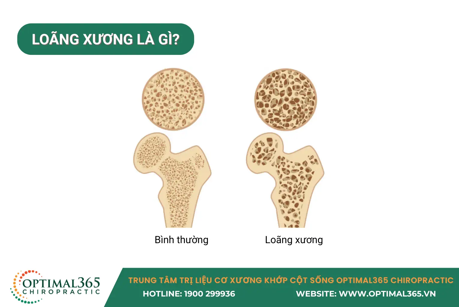 loãng xương