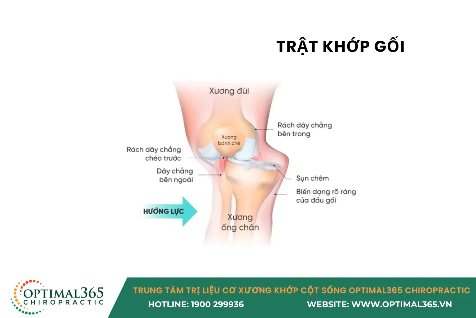 TRẬT KHỚP GỐI