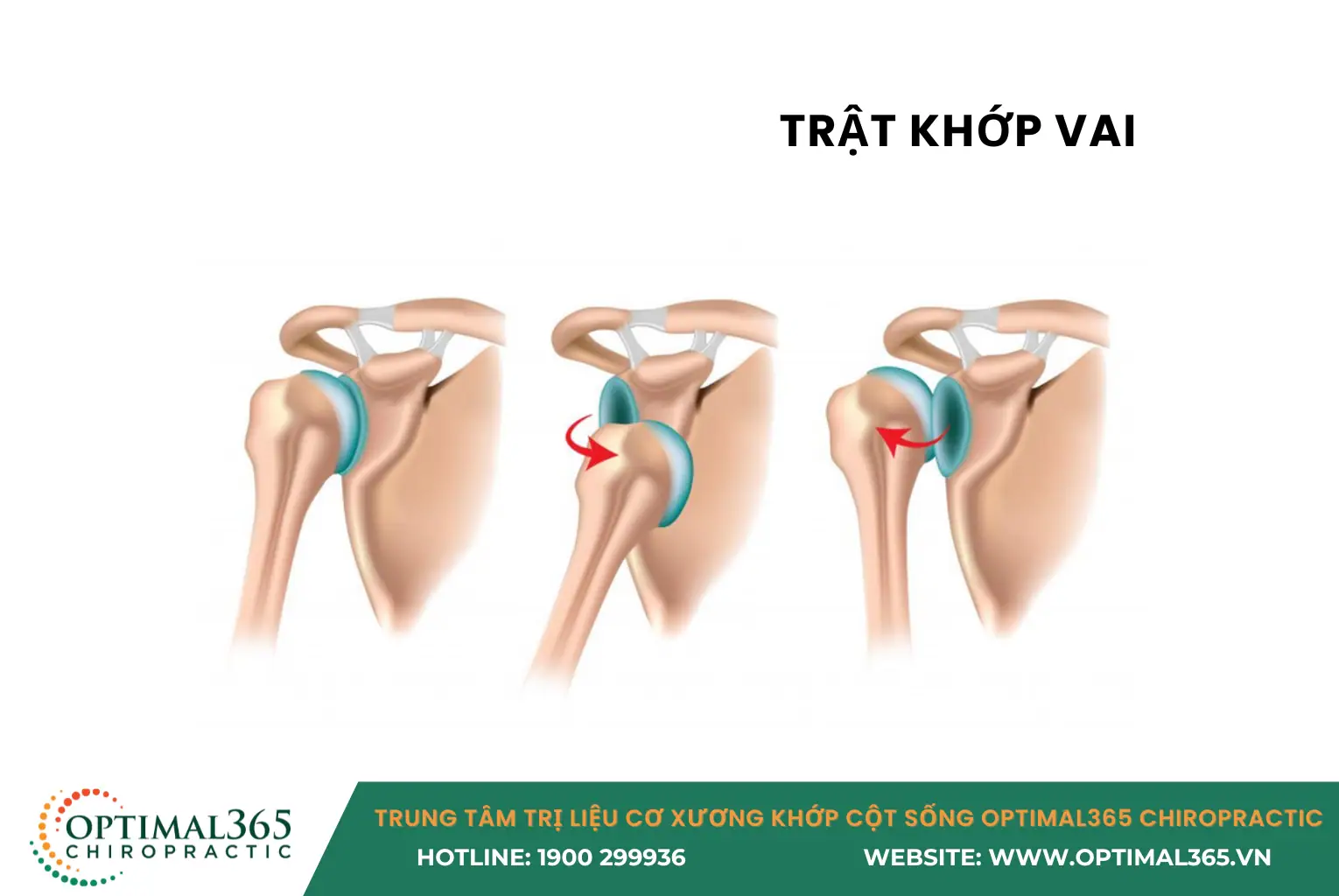 TRẬT KHỚP VAI