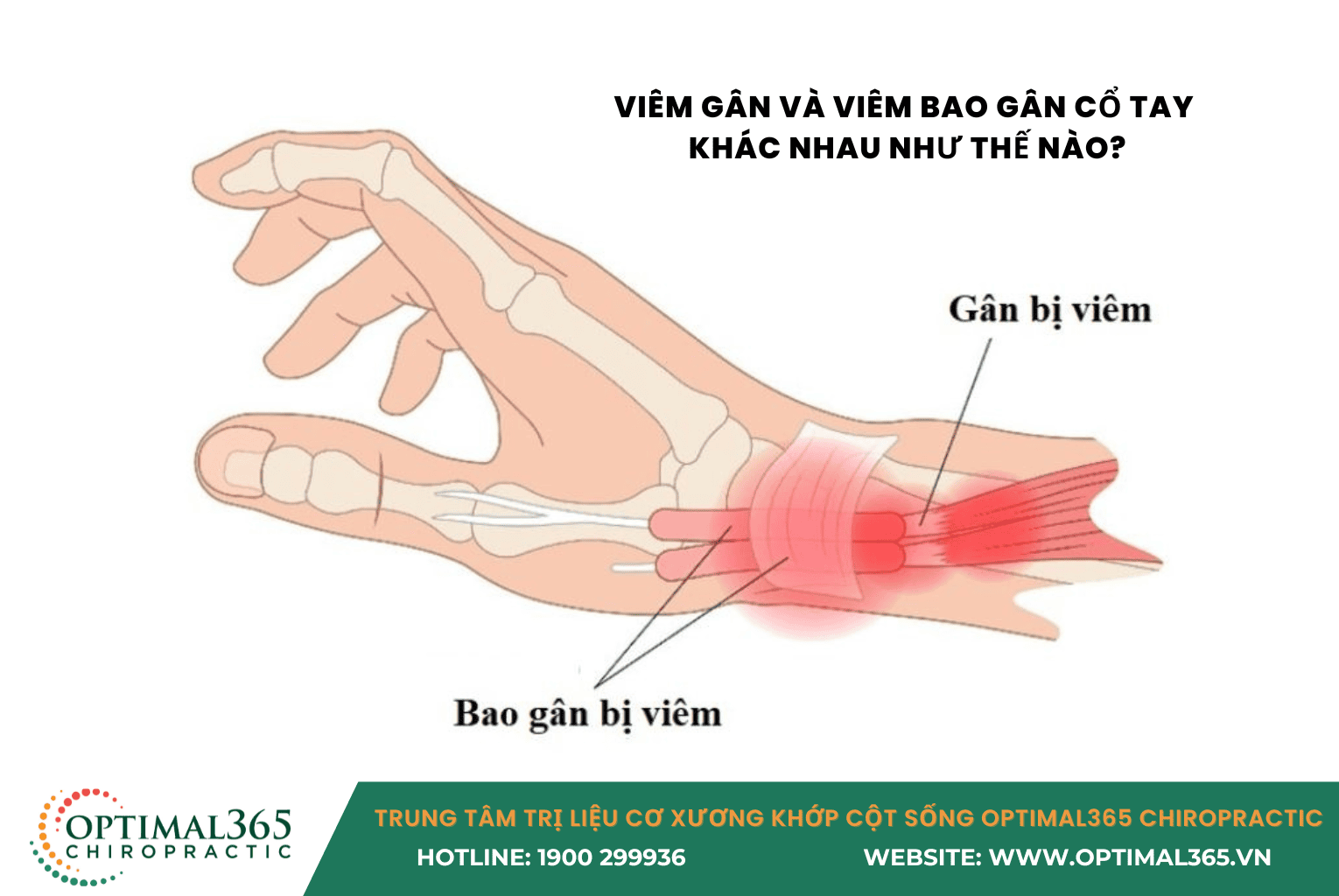 Viêm gân và viêm bao gân cổ tay khác nhau như thế nào?