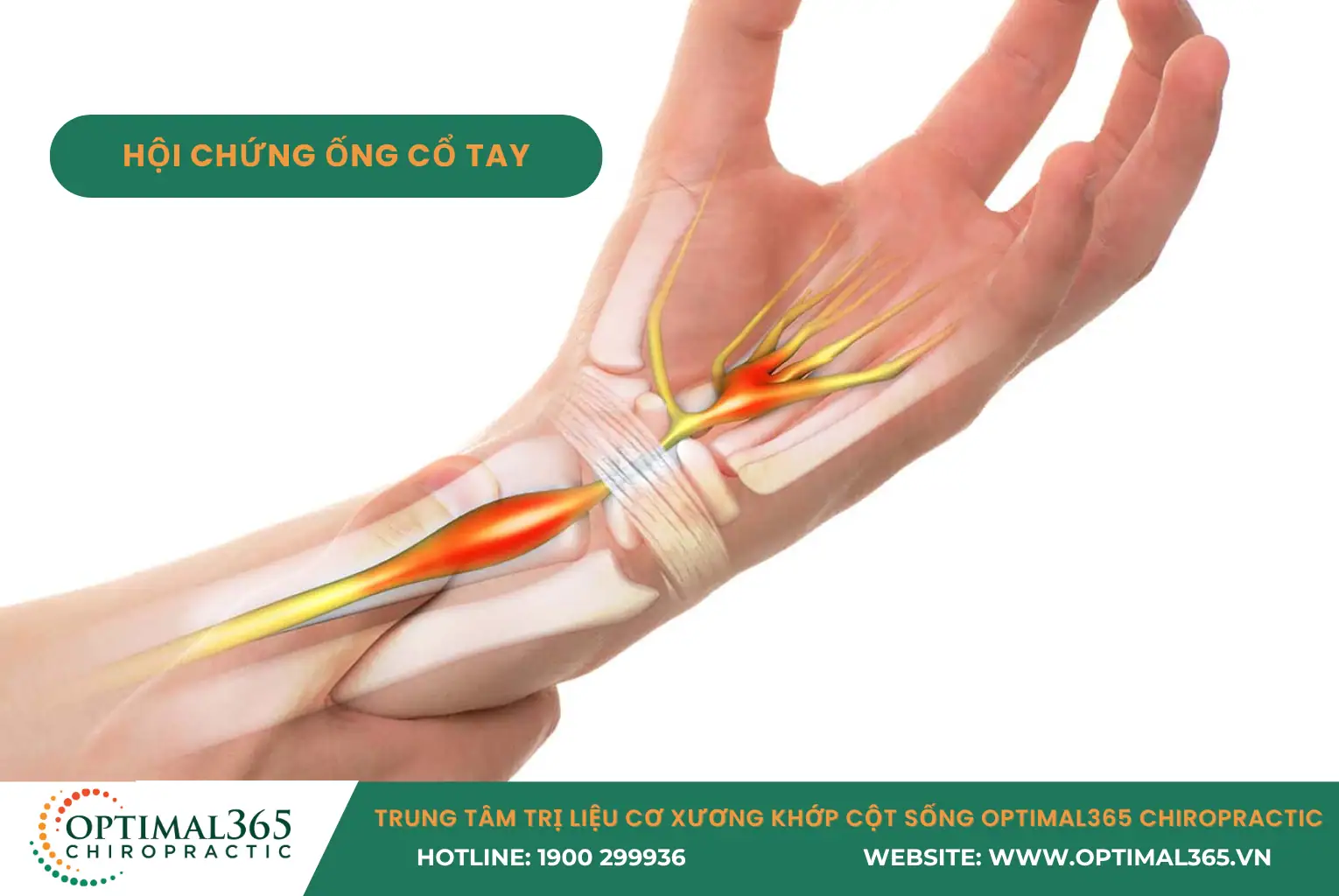 hội chứng ống cổ tay - bệnh lý gây tê tay khi ngủ